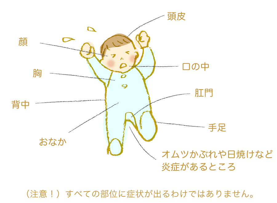 発疹や水ぶくれが現れるところ